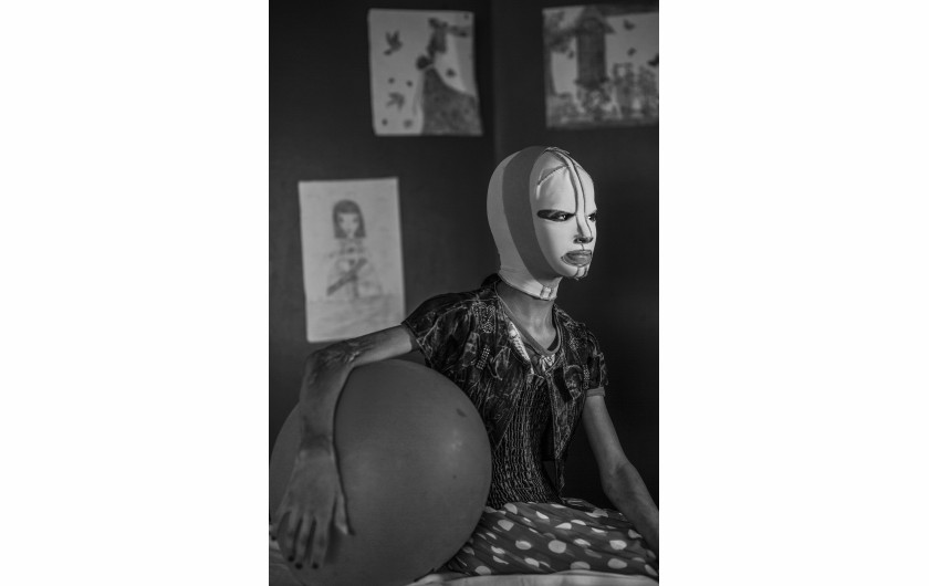 © Alessio Mamo (Redux Pictures), Manal, War Portraits - nominacja w PEOPLE SINGLES / Manal (11 lat), ofiara wybuchu pocisku w Kirkuku w Iraku, nosi maskę przez kilka godzin dziennie, aby chronić twarz po skomplikowanej operacji plastycznej w Szpitalu Al-Mowasah w Ammanie w Jordanii.