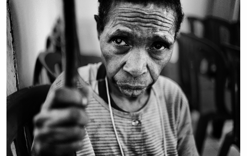 fot. Thaib Chaidar, .1 miejsce w kategorii reportażowej Open Award. Seria dokumentuje darmowe operacje katarakty wśród mieszkańców Papui Nowej Gwinei. Jedną z pacjentek była Sorina Ullo, która po dziesięcioleciach cierpienia mogła wreszcie znów normalnei spojrzeć na świat.